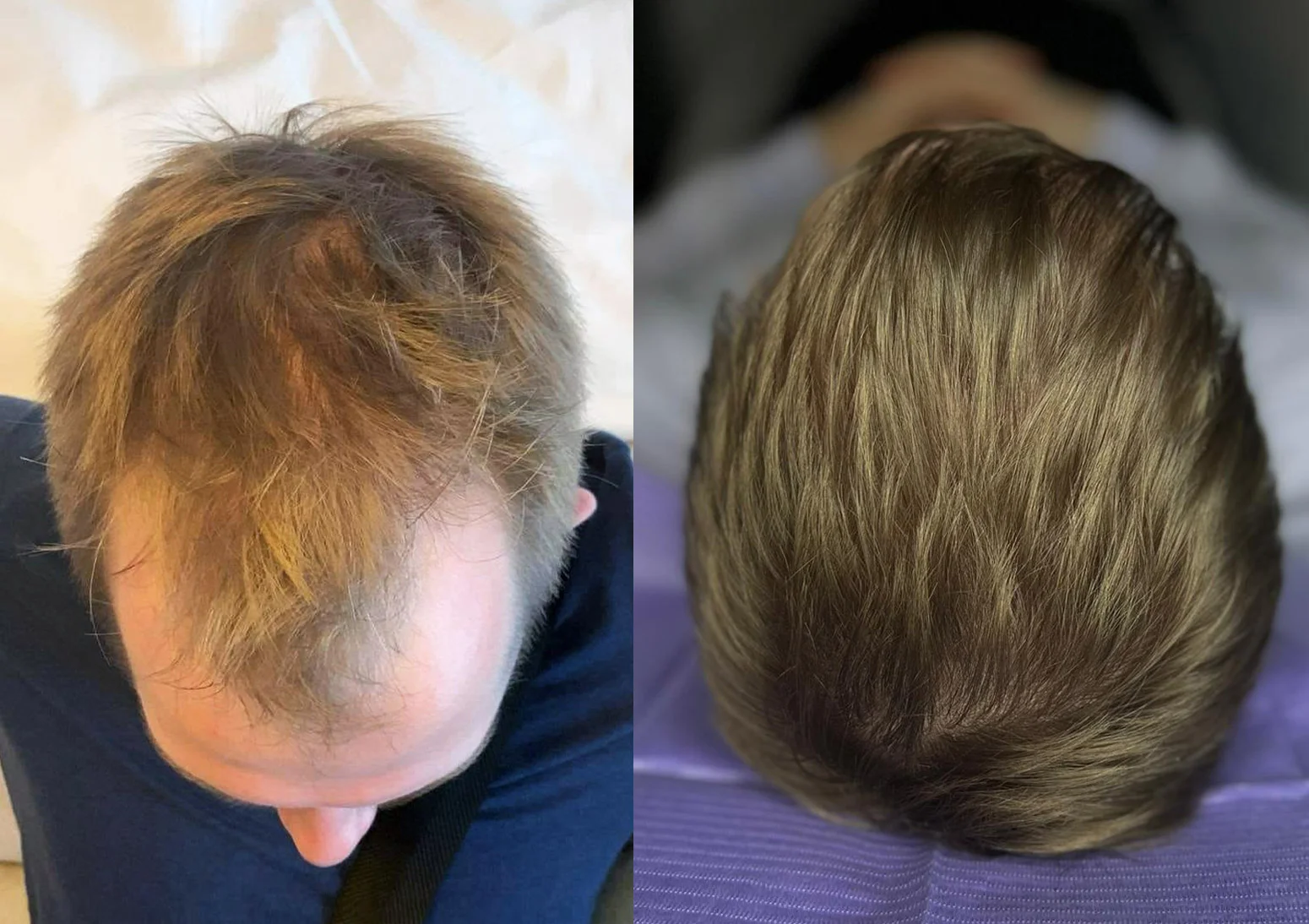 Hair Transplant – Before and After Photos