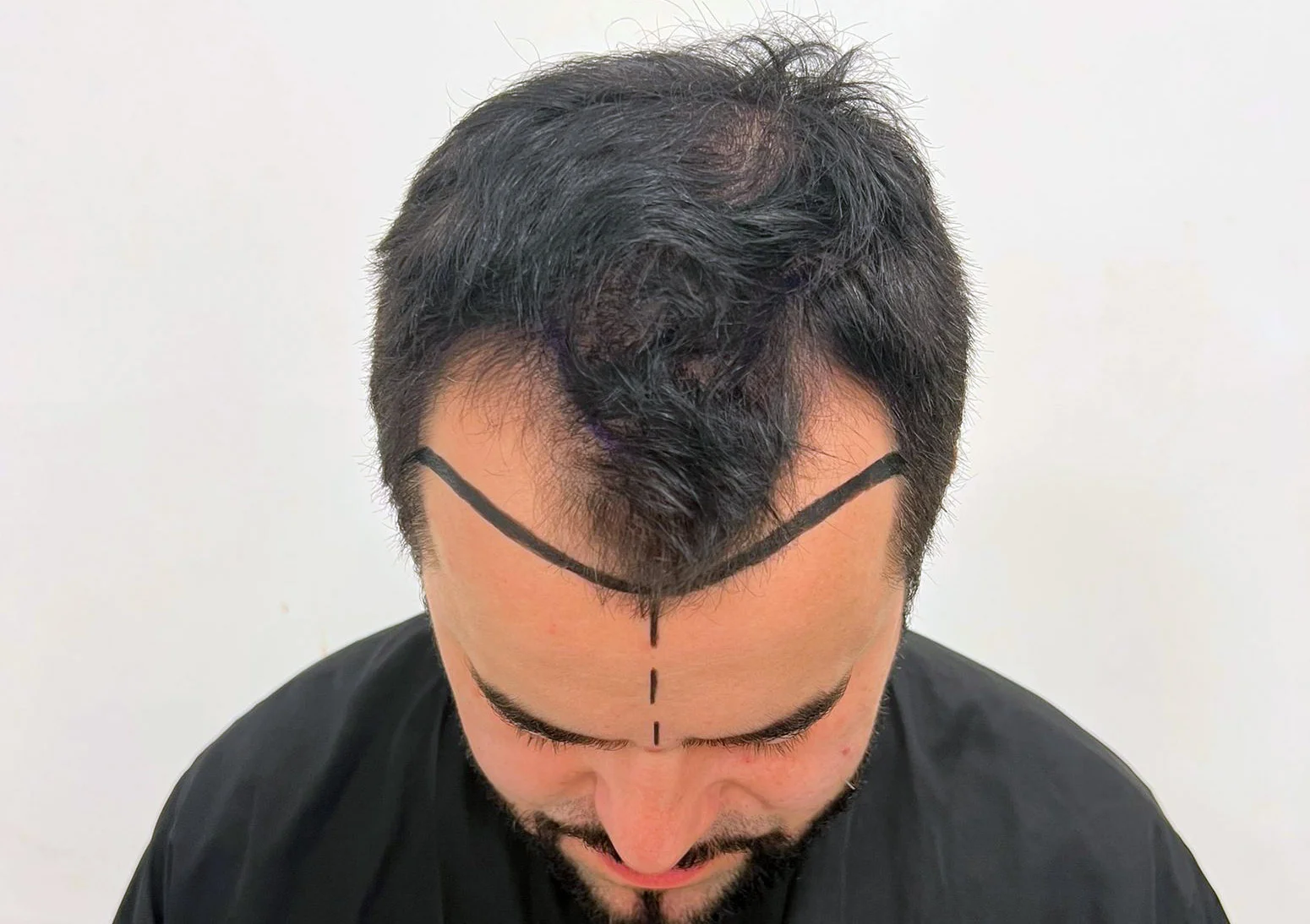 Hair Transplant Receding Hairline